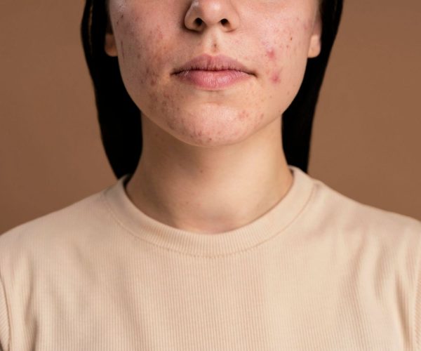 confident-young-woman-with-acne-close-up